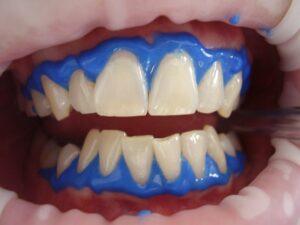 Cosmetic dentist in Ottawa performing a teeth whitening treatment for a brighter smile